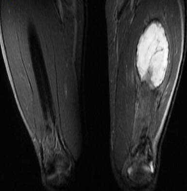Figure 5 for case vastus intermedius intramuscular hematoma ( RID2702 )